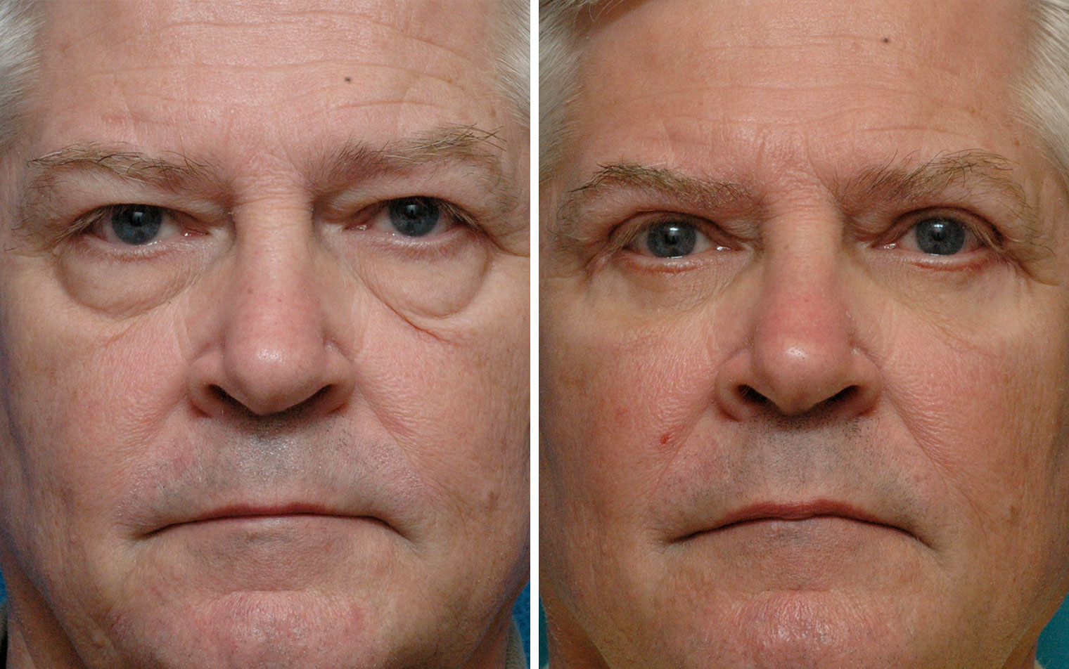 Lower Eyelid Pictures After Surgery 25