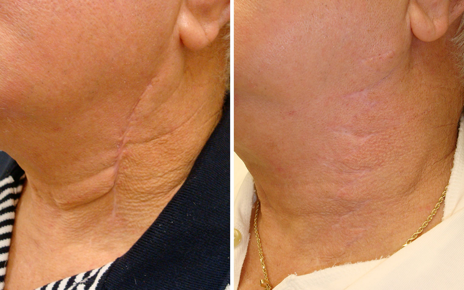 Scar Removal Annapolis Md Scar Revision Severna Park