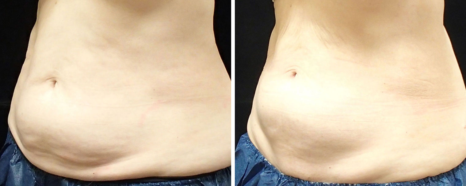 coolsculpting sculpting before results disclaimer procedure annapolis vary md