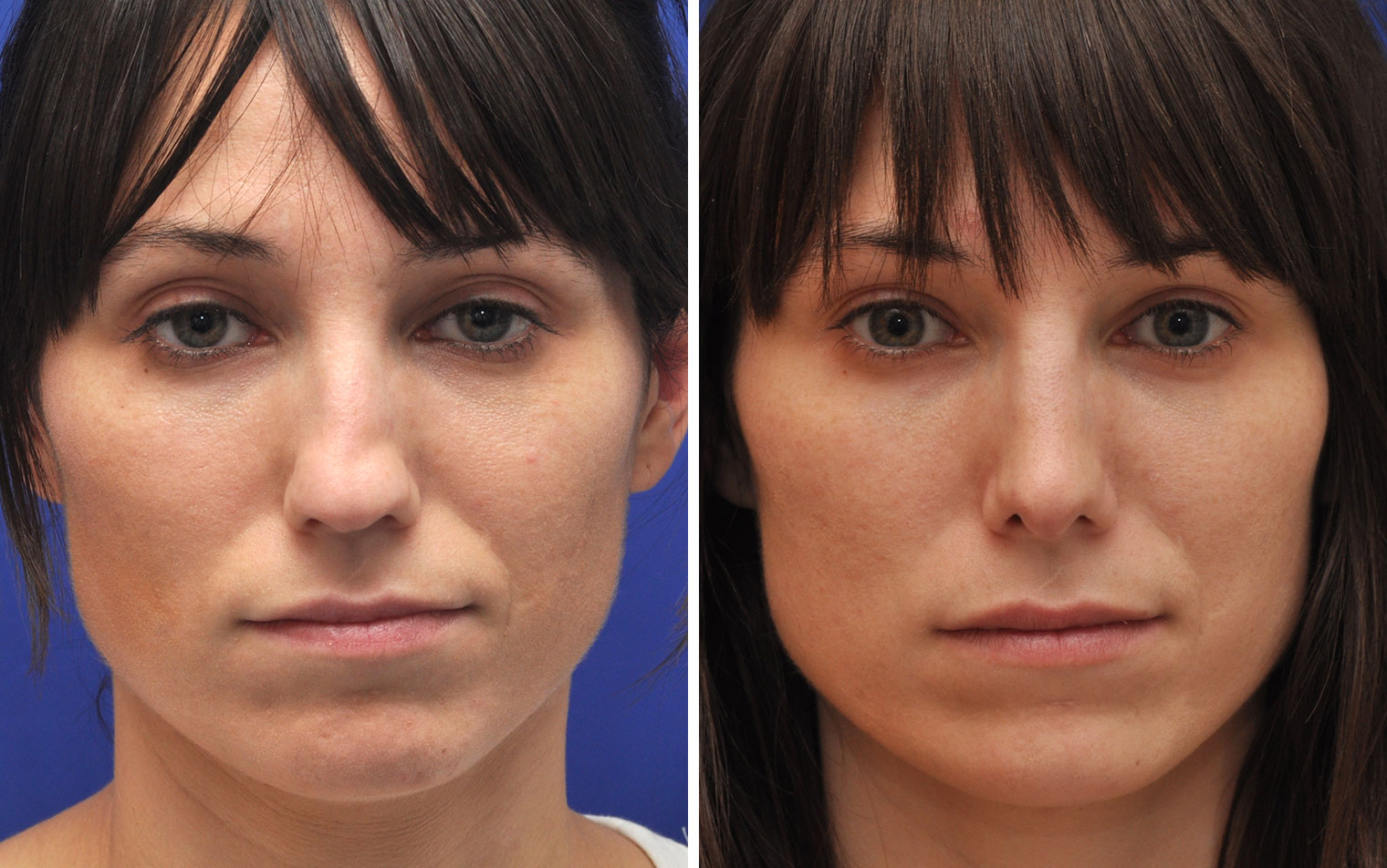Rhinoplasty Before & After Photos Annapolis MD Nose Job