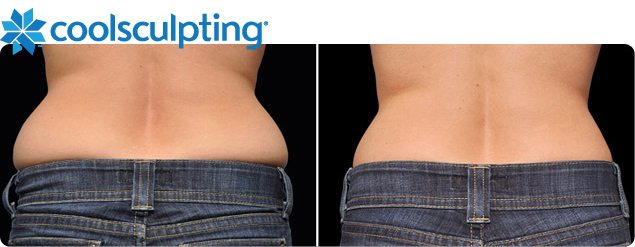 Coolsculpting NYC