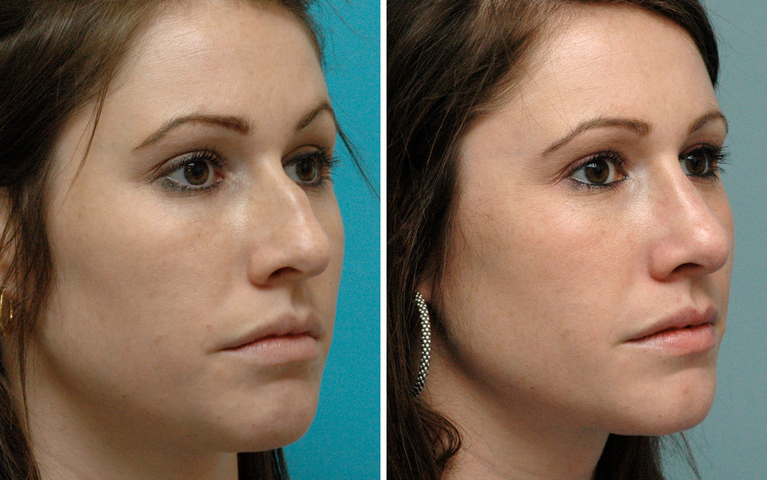 nose job, is a quick, virtually painless procedure done via hyaluronic acid...