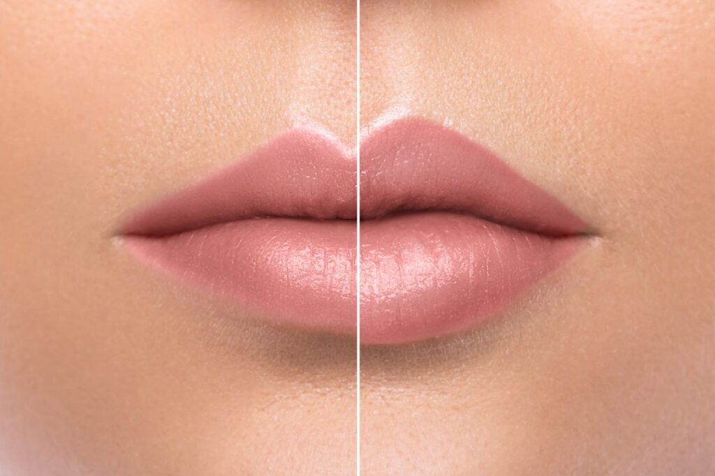 female lips showing difference before after augmentation