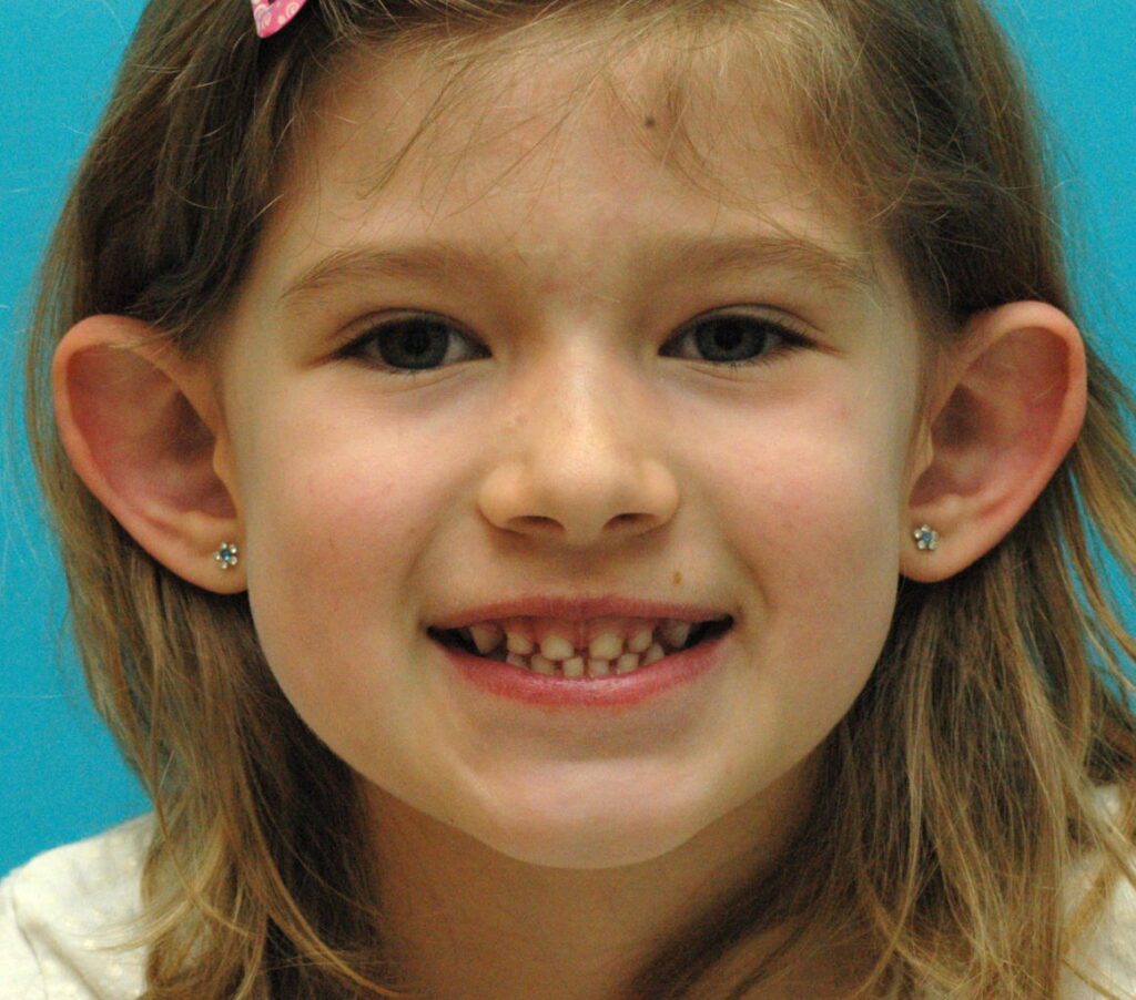Otoplasty light brown hair child patient protruding ears with earrings