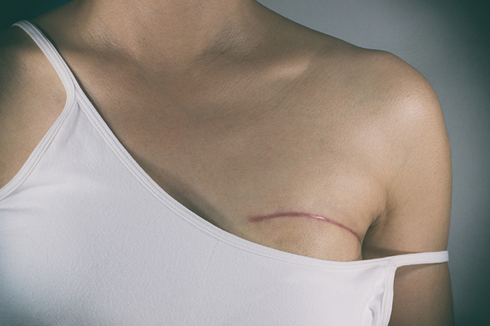 female in white shirt with scar above her breast