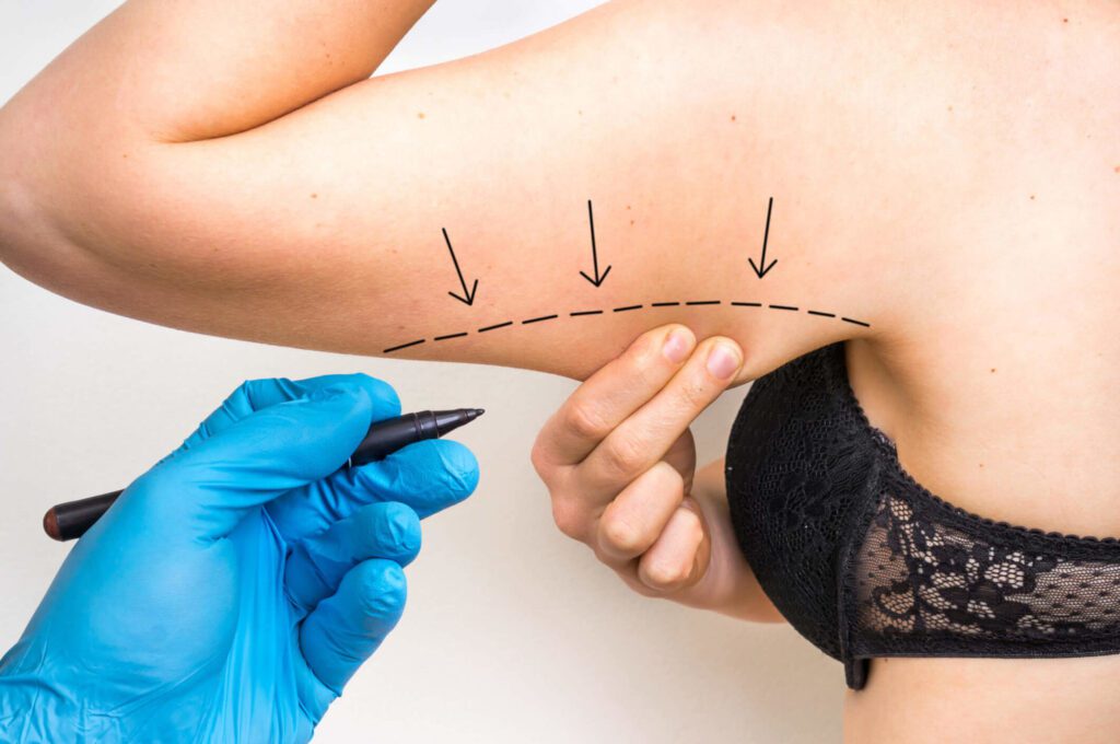 female patient pulling on excess skin under arm doctor marking with black ink