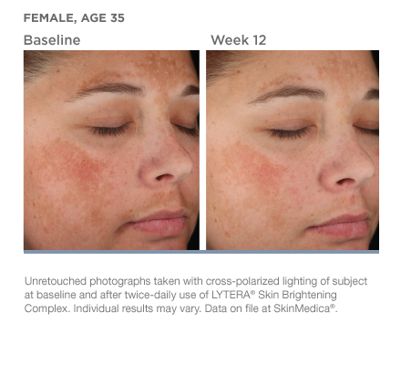 Before & After Lytera Skin Brightening Complex