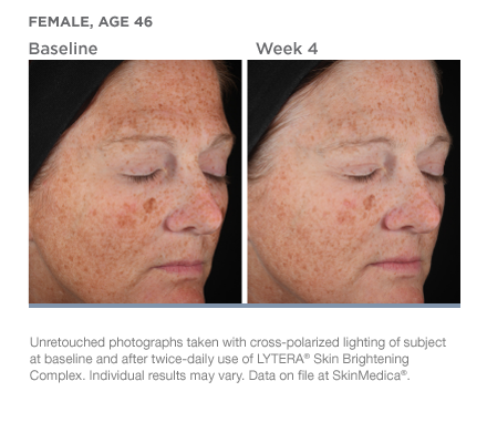 Before & After SkinMedica Brightening Complex