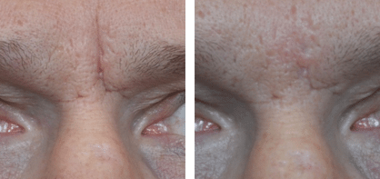 restylane-before-and-after