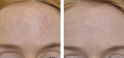 Scar removal before and after female blonde hair