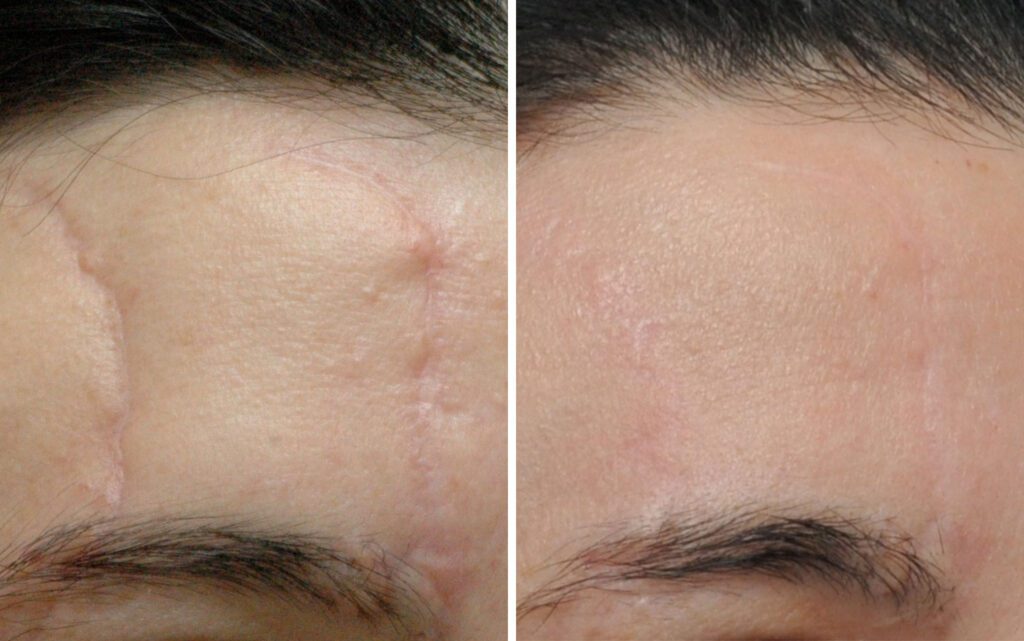 black hair scar revision before and after