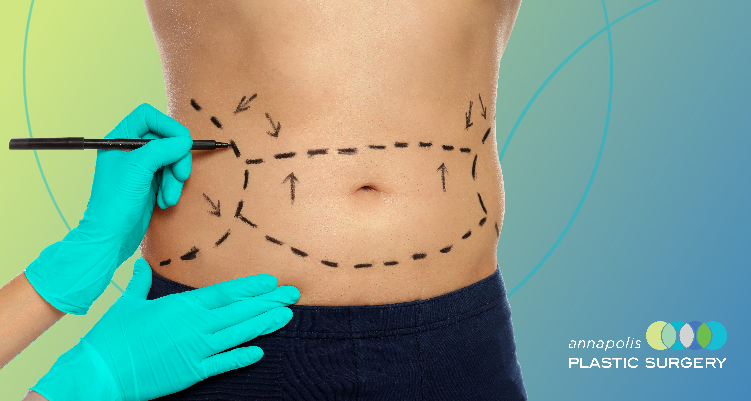 Are you a man struggling to get rid of stubborn fat despite exercise and having a healthy diet? You're not alone. Liposuction, or Lipo, is one of the most common cosmetic procedures for men and could be the solution you're looking for.