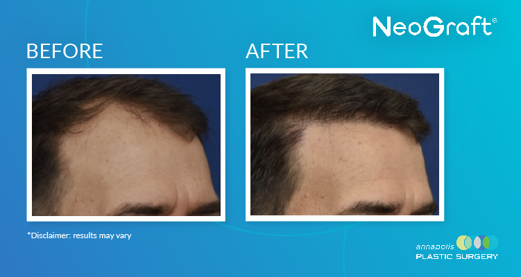 Are you struggling with hair loss and looking for a solution that provides natural-looking results? Look no further! Annapolis Plastic Surgery now offers NeoGraft, an innovative hair restoration technique that is gaining popularity due to its incredible benefits and minimal recovery time.